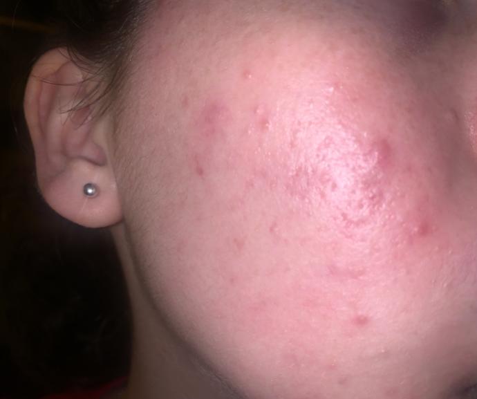 Is this acne, pimples, or scarring?