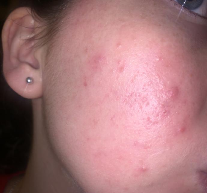 Is this acne, pimples, or scarring?
