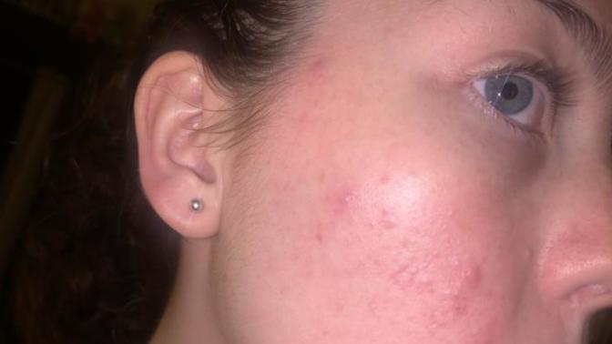 Is this acne, pimples, or scarring?