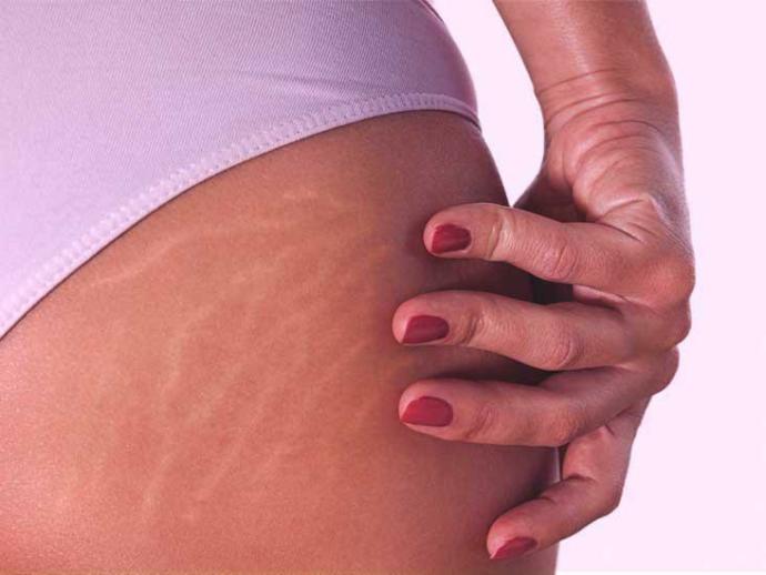 Why do guys like stretch marks on a girl?