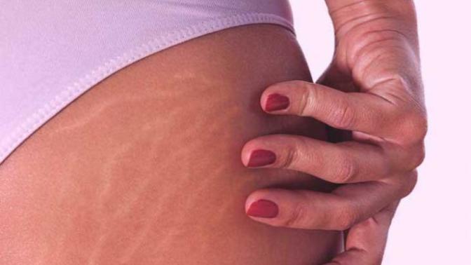Why do guys like stretch marks on a girl?