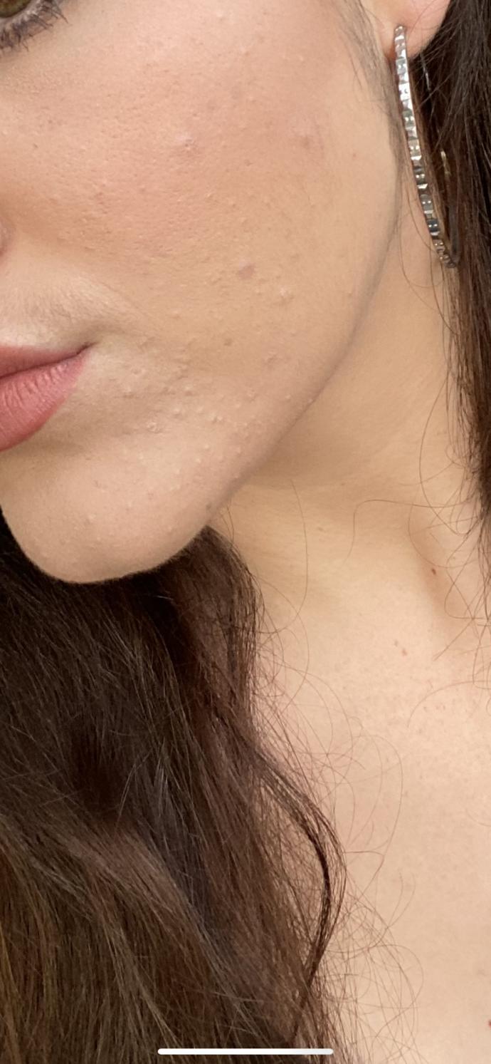 How to get rid of irritating whiteheads on my chin?