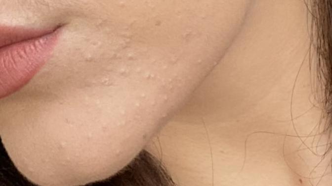 How to get rid of irritating whiteheads on my chin?