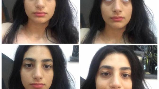 Can I ever get rid of my dark circles?