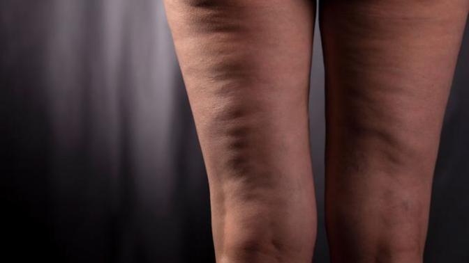 Do most of the women have cellulite?