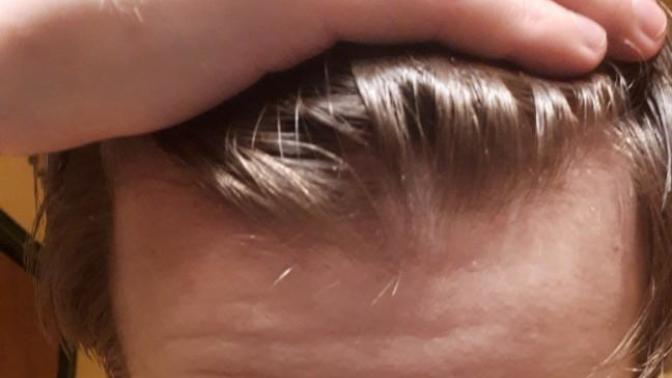 How do I stop hairloss?