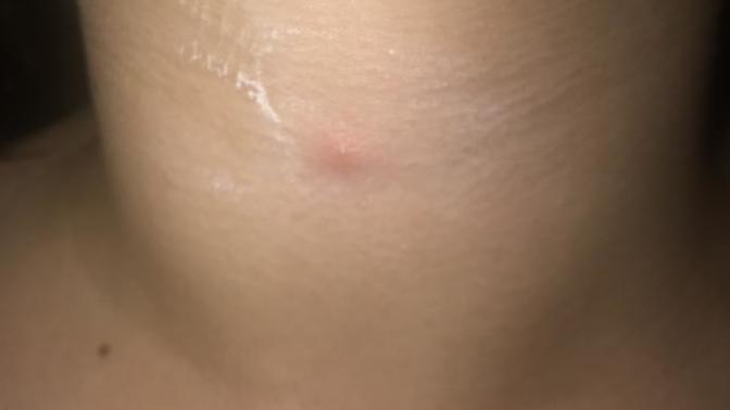 Is this a pimple?