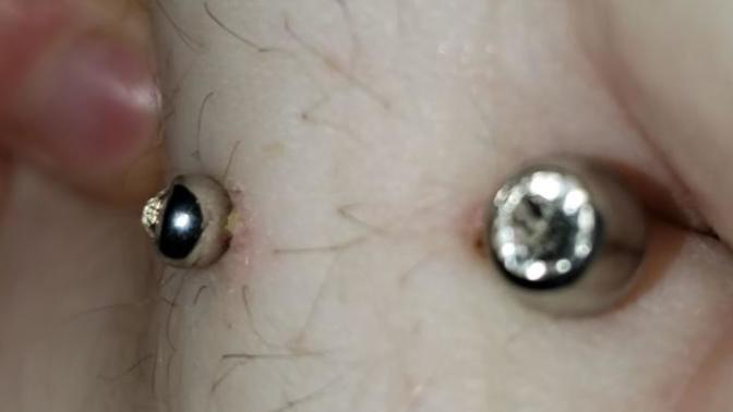 Is my navel piercing possibly infected or just irritated?