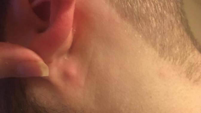 What is this behind my ear lobe?