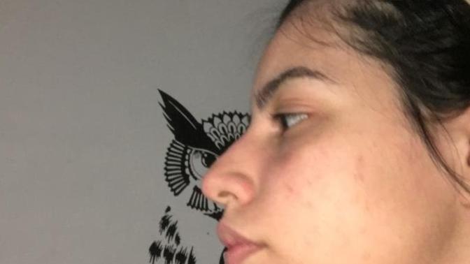 What can I use for my acne?