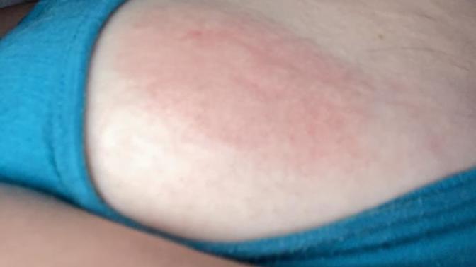 Should I be concerned about this place on my boob?