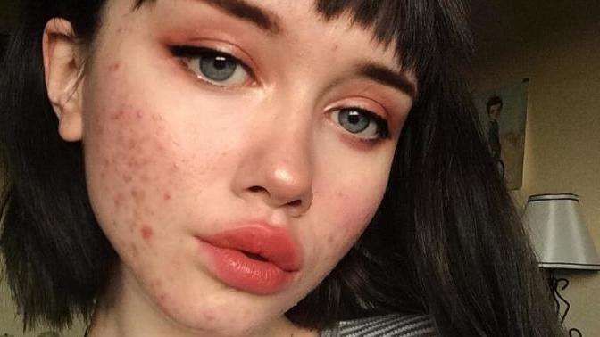 A Girl with a Great Body & Pretty Face, but Bad Acne. Thoughts?