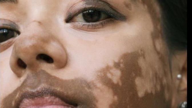 I do not have vitiligo - is it appropriate for me to write a picture book about a character with vitiligo?