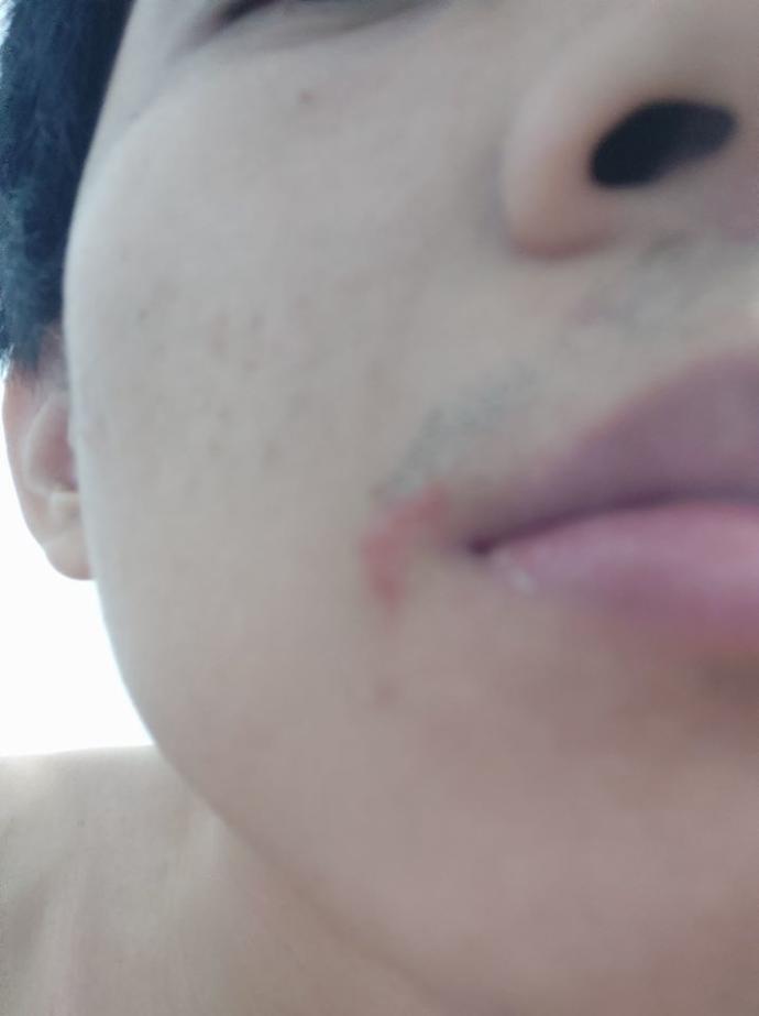Is this COLD SORE?