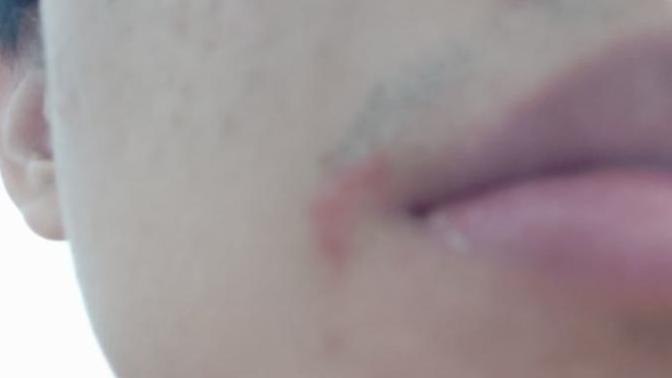 Is this COLD SORE?