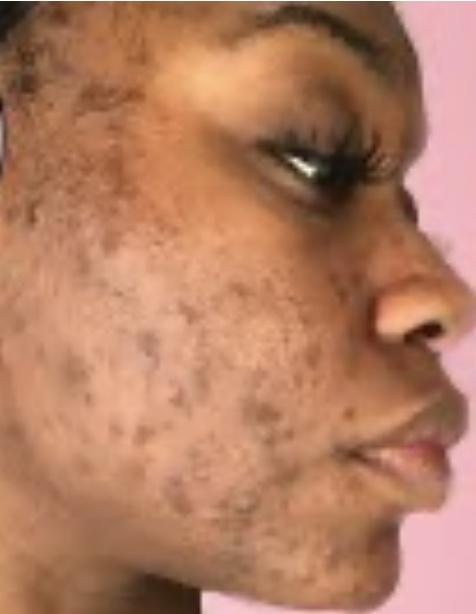 Guys, White men -if u went to a PLATONIC hobbygroup + met a woman with this skin-would u blank her + only talk 2 white women w clear skin/ good looks?