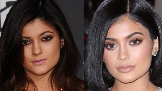 Guys, what would you do if your girlfriend/wife decides to get lip fillers?