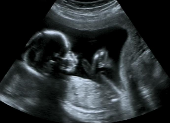 A baby was killed two weeks after birth. The killer was sentenced to life in prison. Another baby was killed two weeks before birth. No crime?