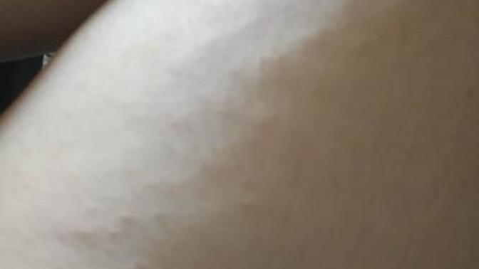 Is this a sign of strech marks?