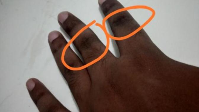 Should I use bleach to get rid of these dark skin tone?