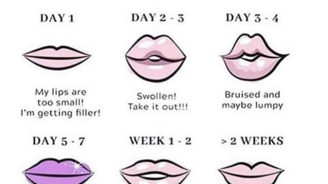 Do your lips go back to normal after fillers?