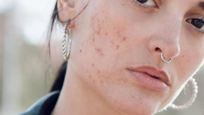 How to get rid of acne/prevent breakouts?