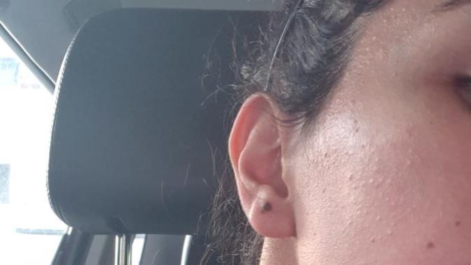 Do you ever get a rash on your face because of heat?