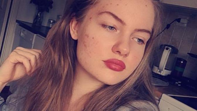 Does my acne look really bad?