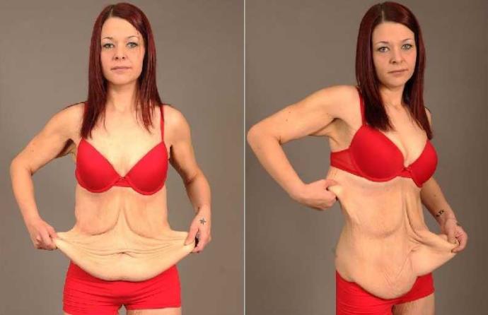 Will I get loose skin if I lose 30kg?