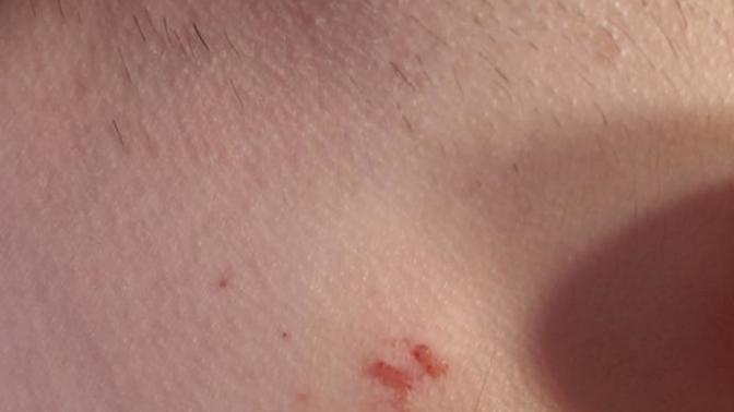 What is this bug bite?