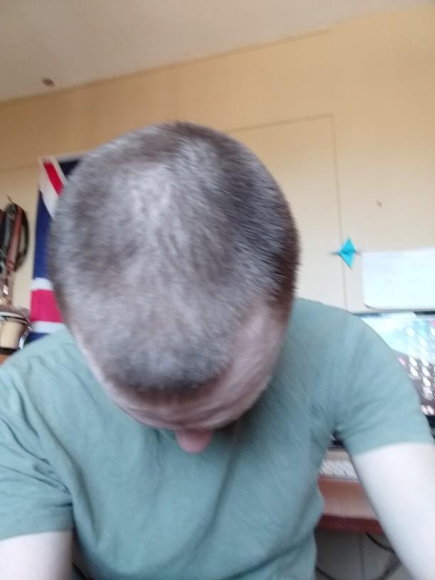 Any doctors in the house? Am I losing my hair?