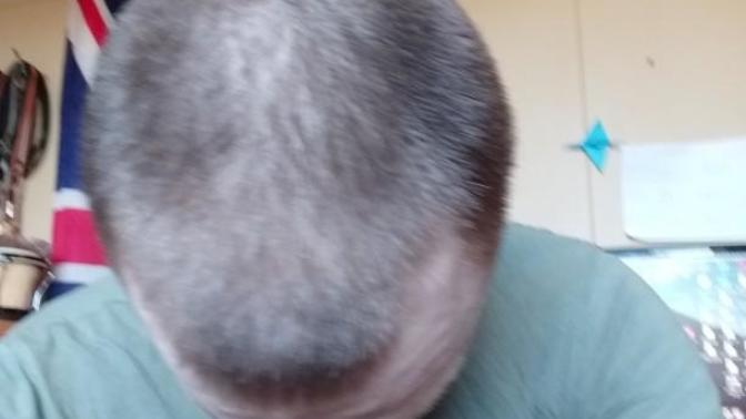 Any doctors in the house? Am I losing my hair?