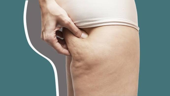Do all women have cellulite? Is it unattractive to men?