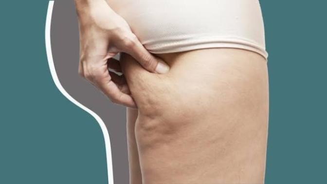 Do all women have cellulite? Is it unattractive to men?