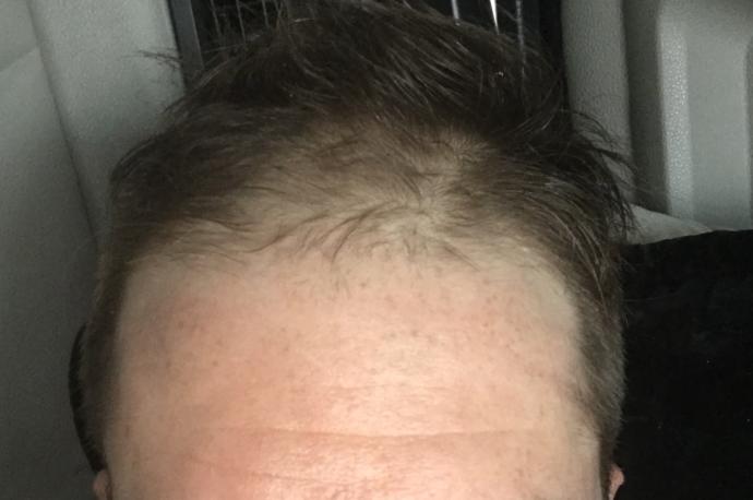 What should this man do with his thinning hair?