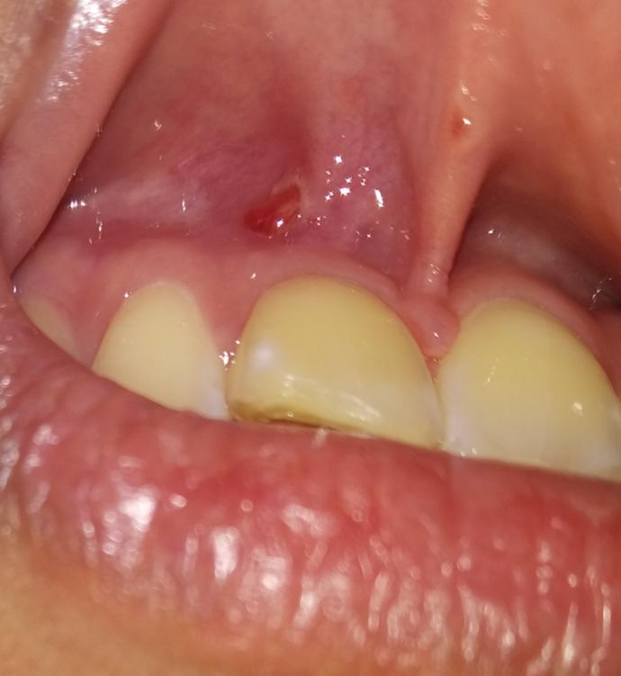 Does anyone ever had gum problem?