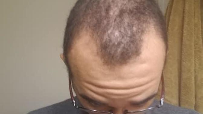 Why do mens hairlines effect their appearance so much?