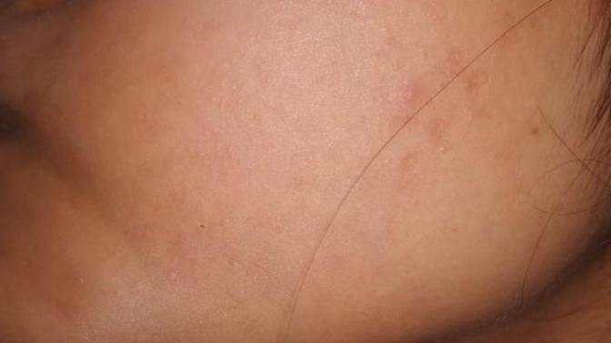 How to get better skin?