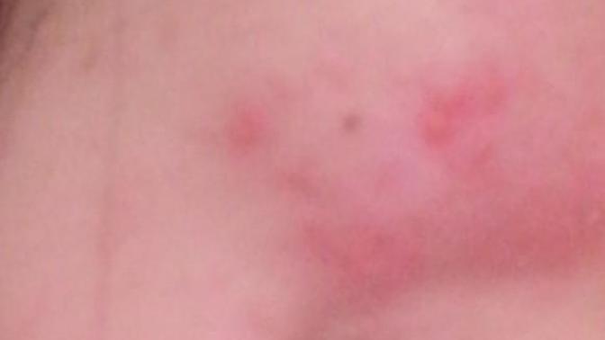 How to get rid of acne? is it even possible to get a clear skin again?