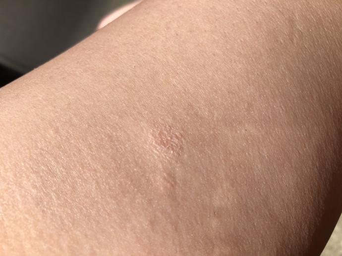 Dating mit einem mädchen mit psoriasis