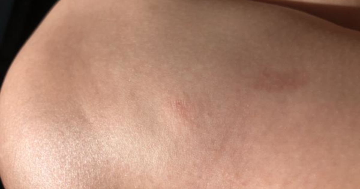 Dating mit einem mädchen mit psoriasis
