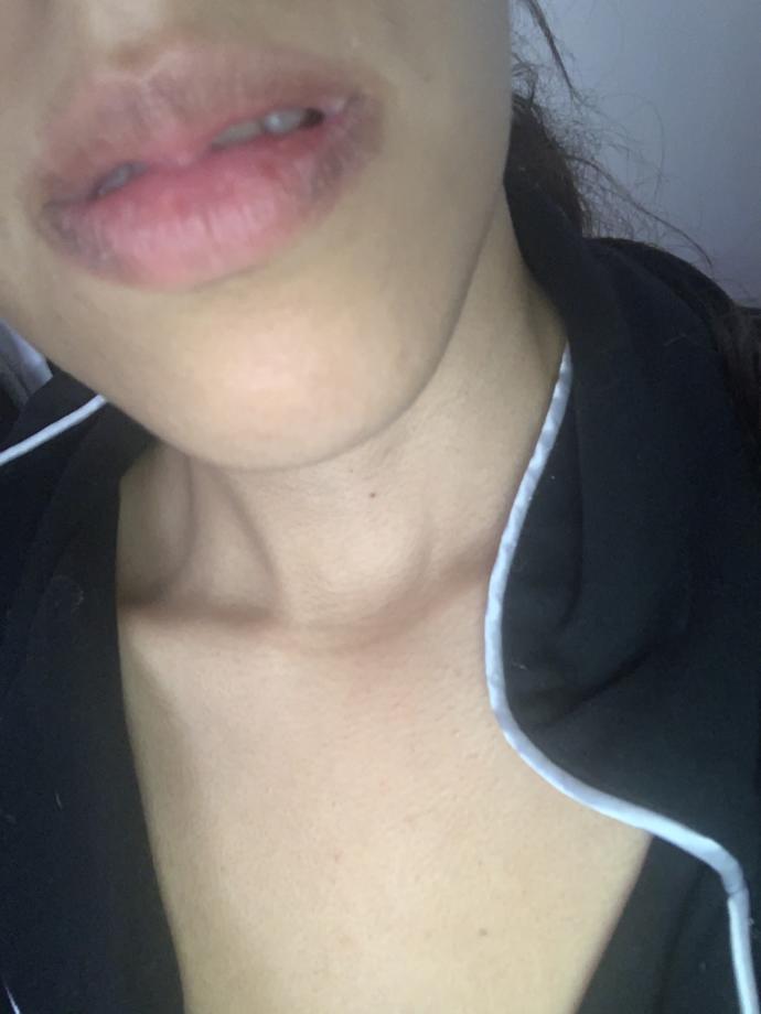 Why are my lips purple and cracked very dry help?