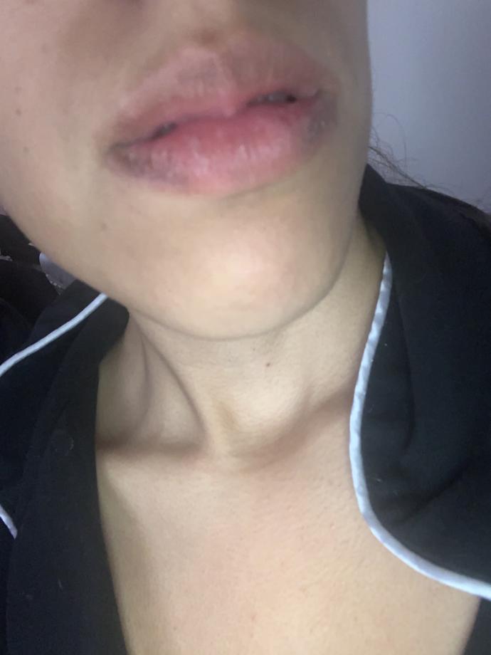 Why are my lips purple and cracked very dry help?