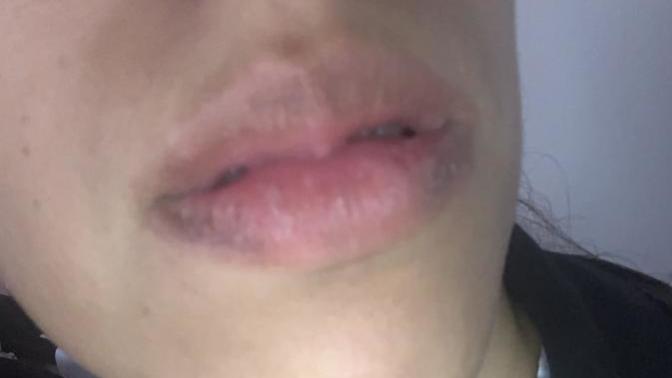 Why are my lips purple and cracked very dry help?