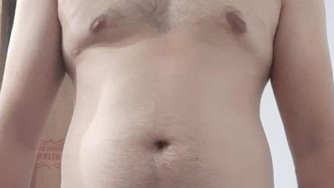 Is this Gynecomastia? Or normal chest?