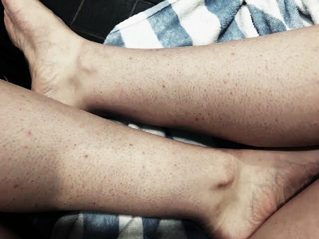 Girls, Razor bumps and ingrowns after shaving?