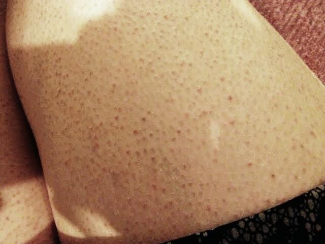 Girls, Razor bumps and ingrowns after shaving?