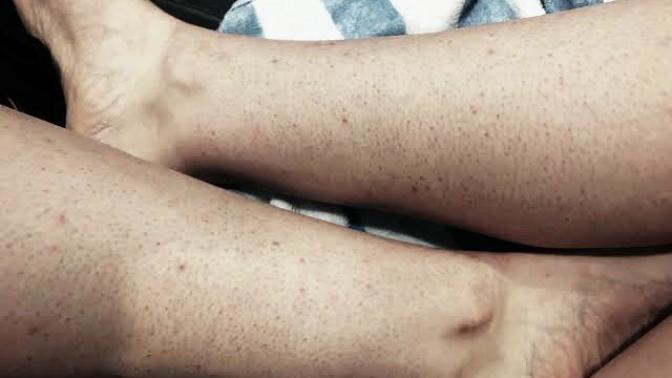 Girls, Razor bumps and ingrowns after shaving?