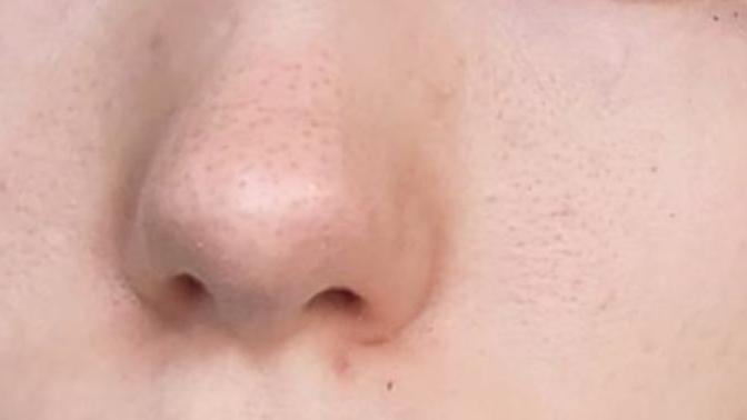 I have really large ugly pores. What can I do to make sure they won't get worse?