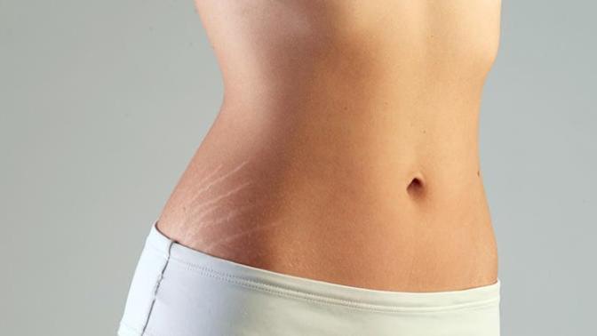 I've been slim my whole life, why do I have stretch marks?